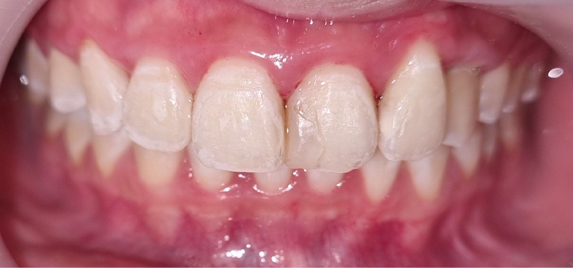 whitening-after