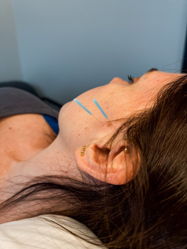 TMJ acupuncture