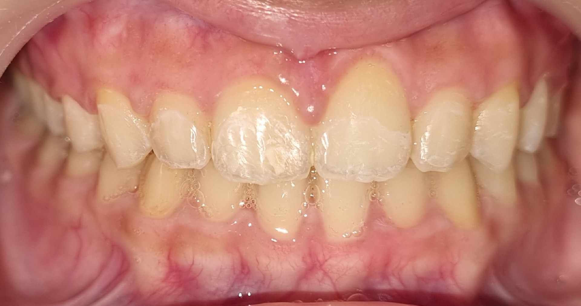 1-braces-after