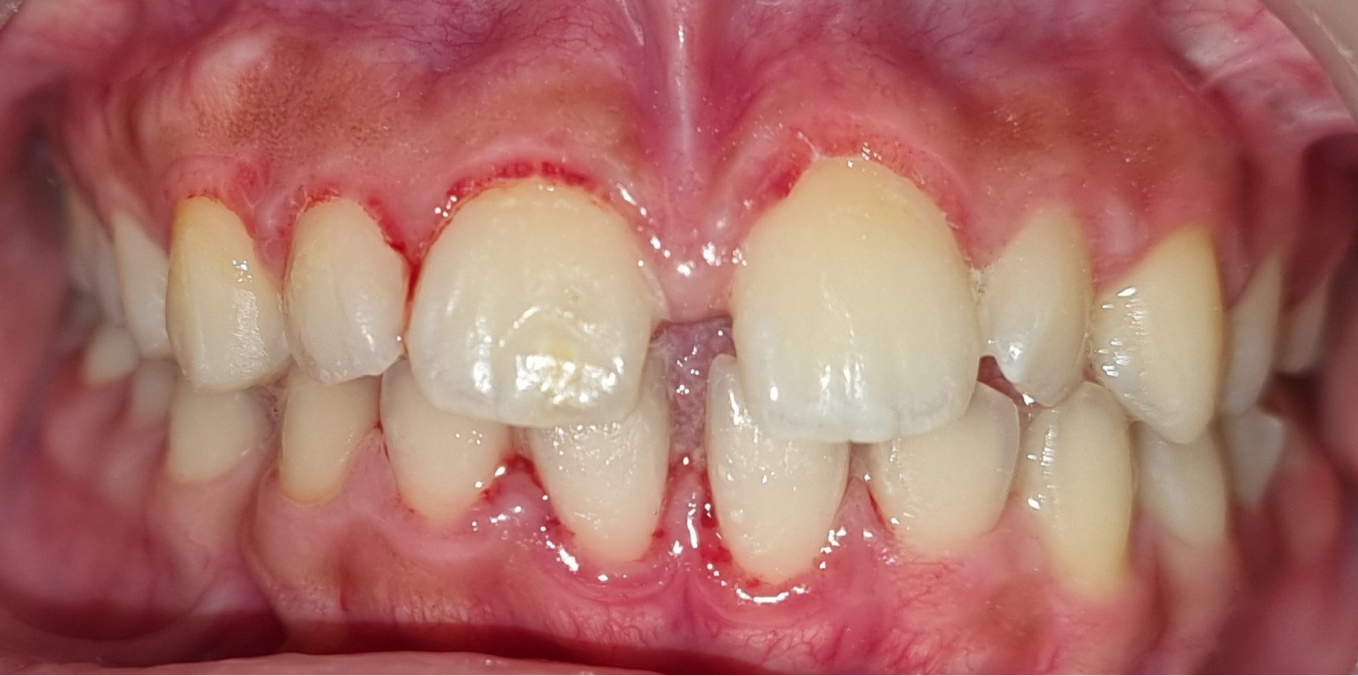 1-braces-before