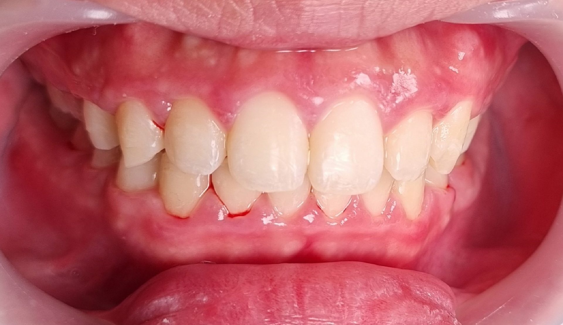 2-braces-after
