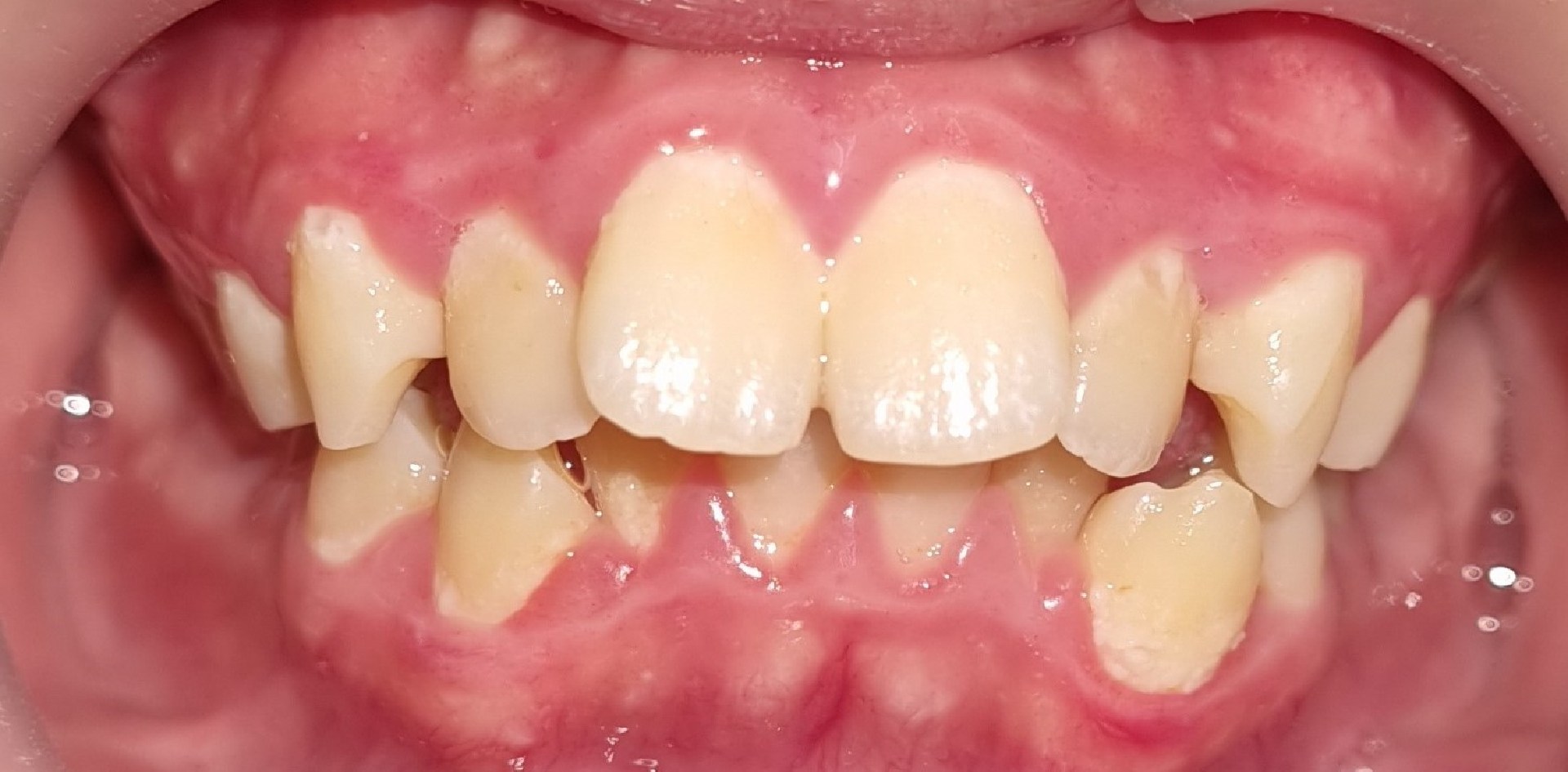 2-braces-before