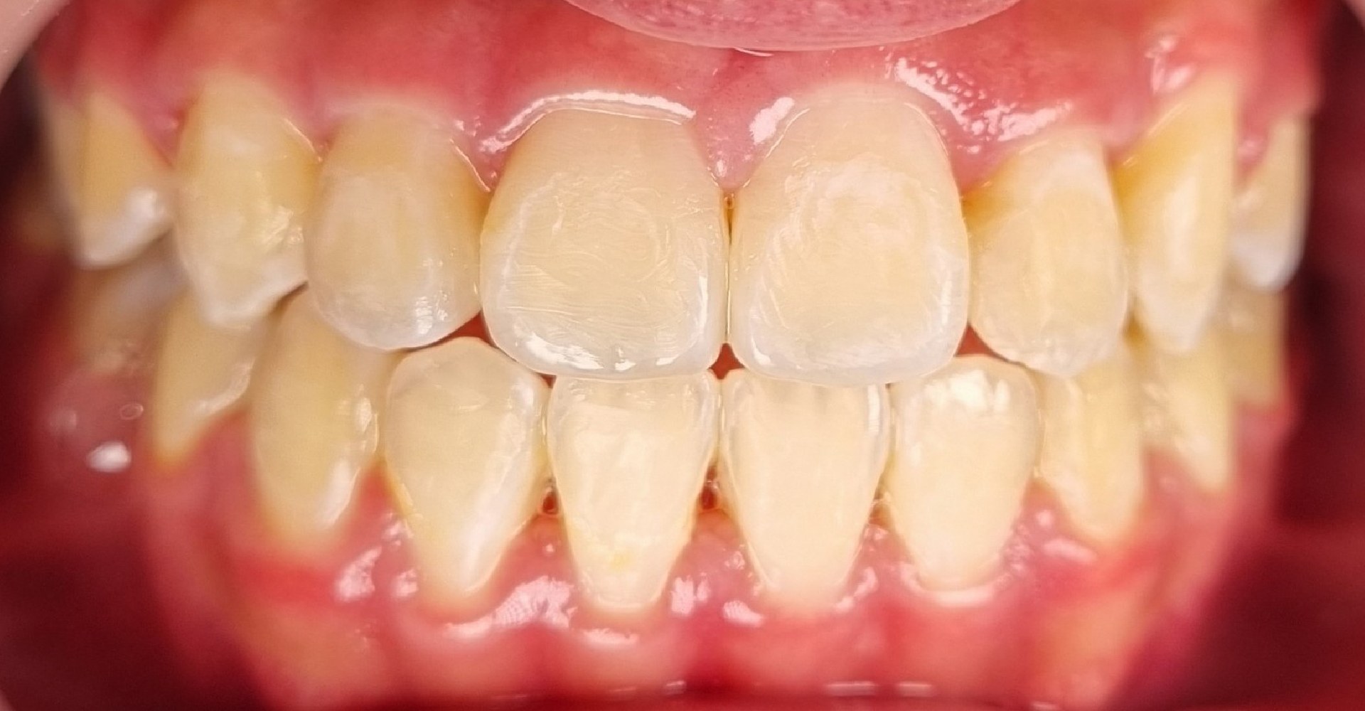 3-braces-after-edit