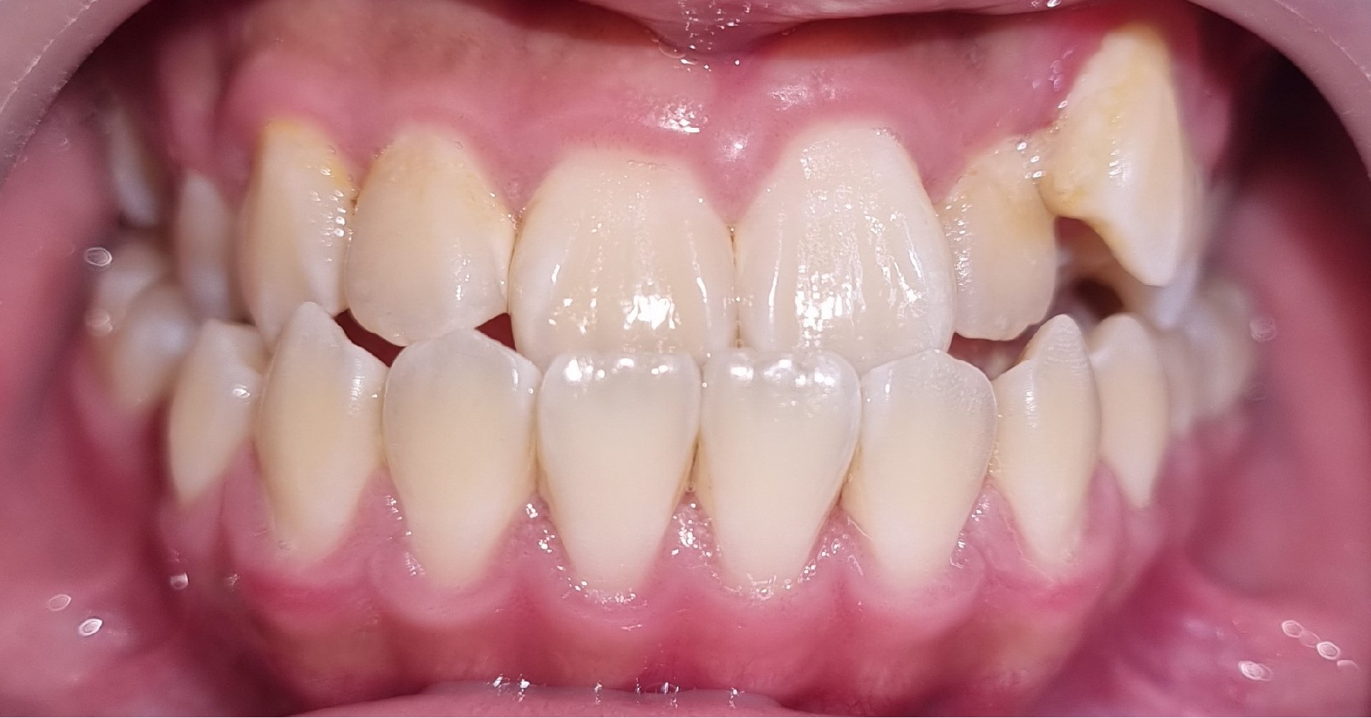 3-braces-before