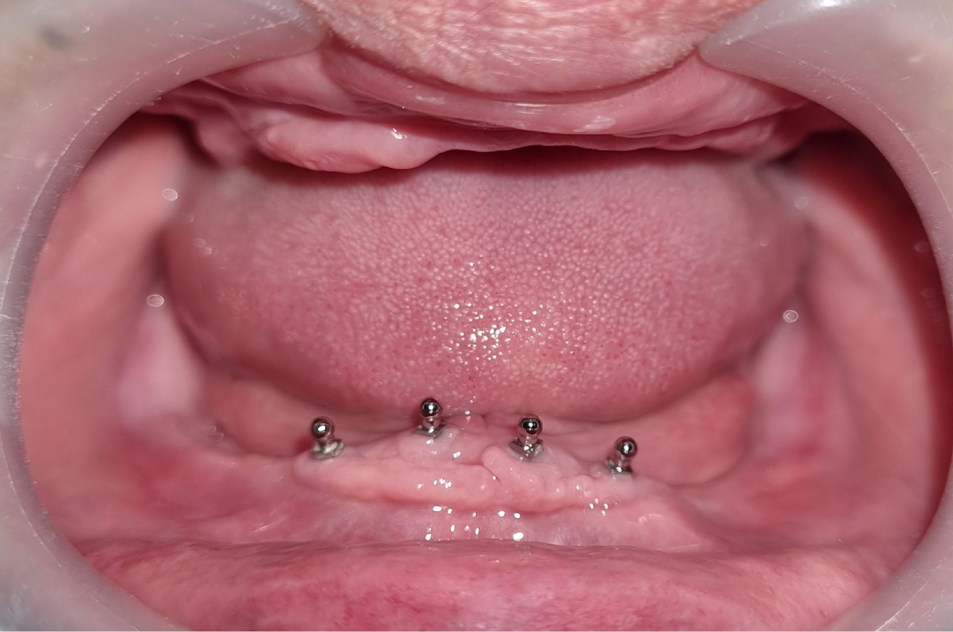 denture-before