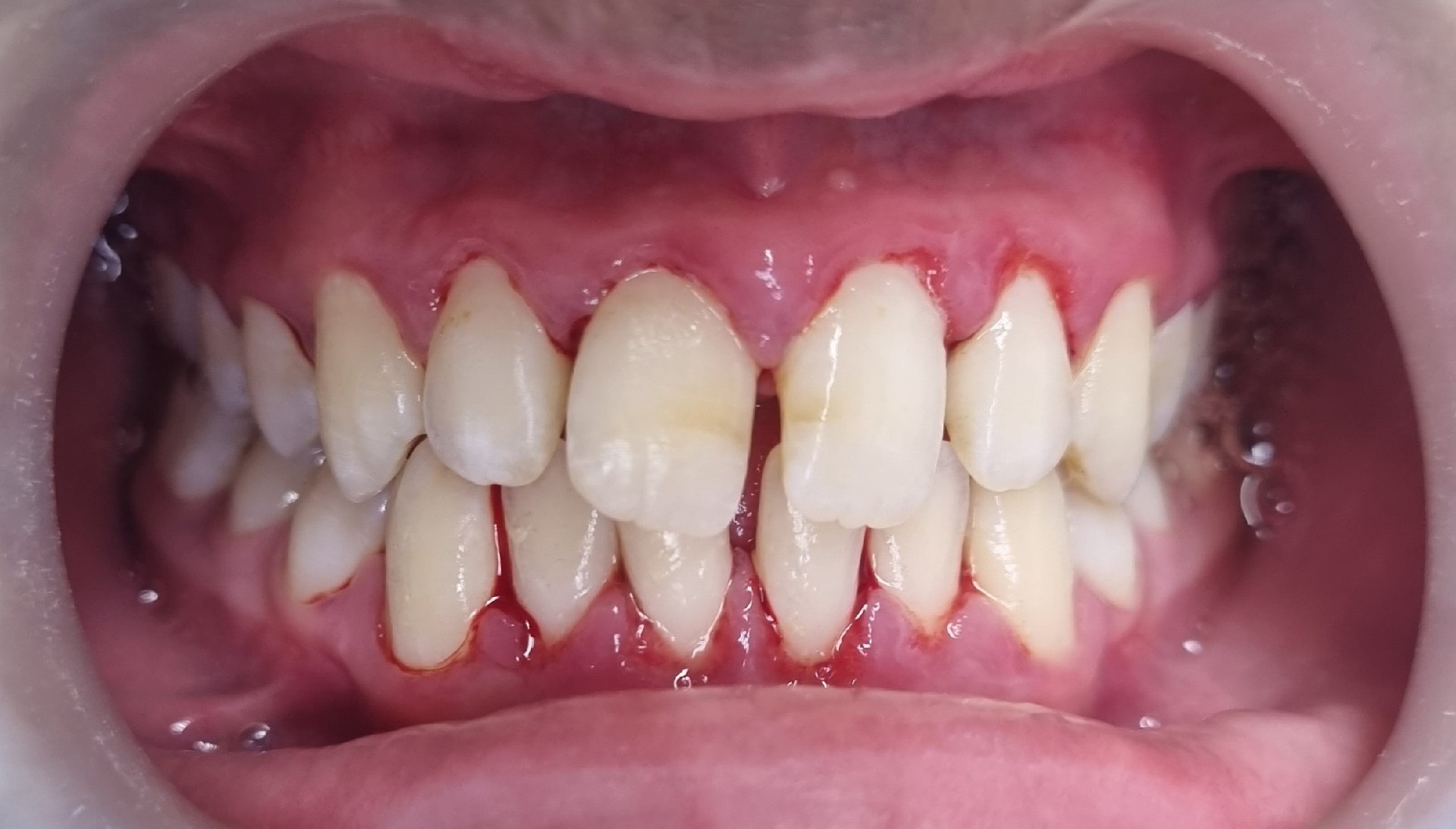 scaling-after