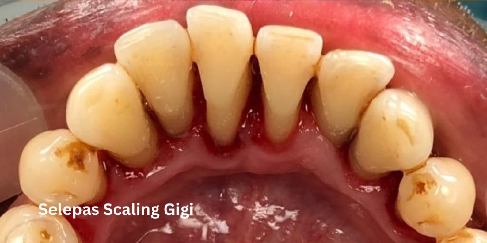 scaling-gigi-after-2