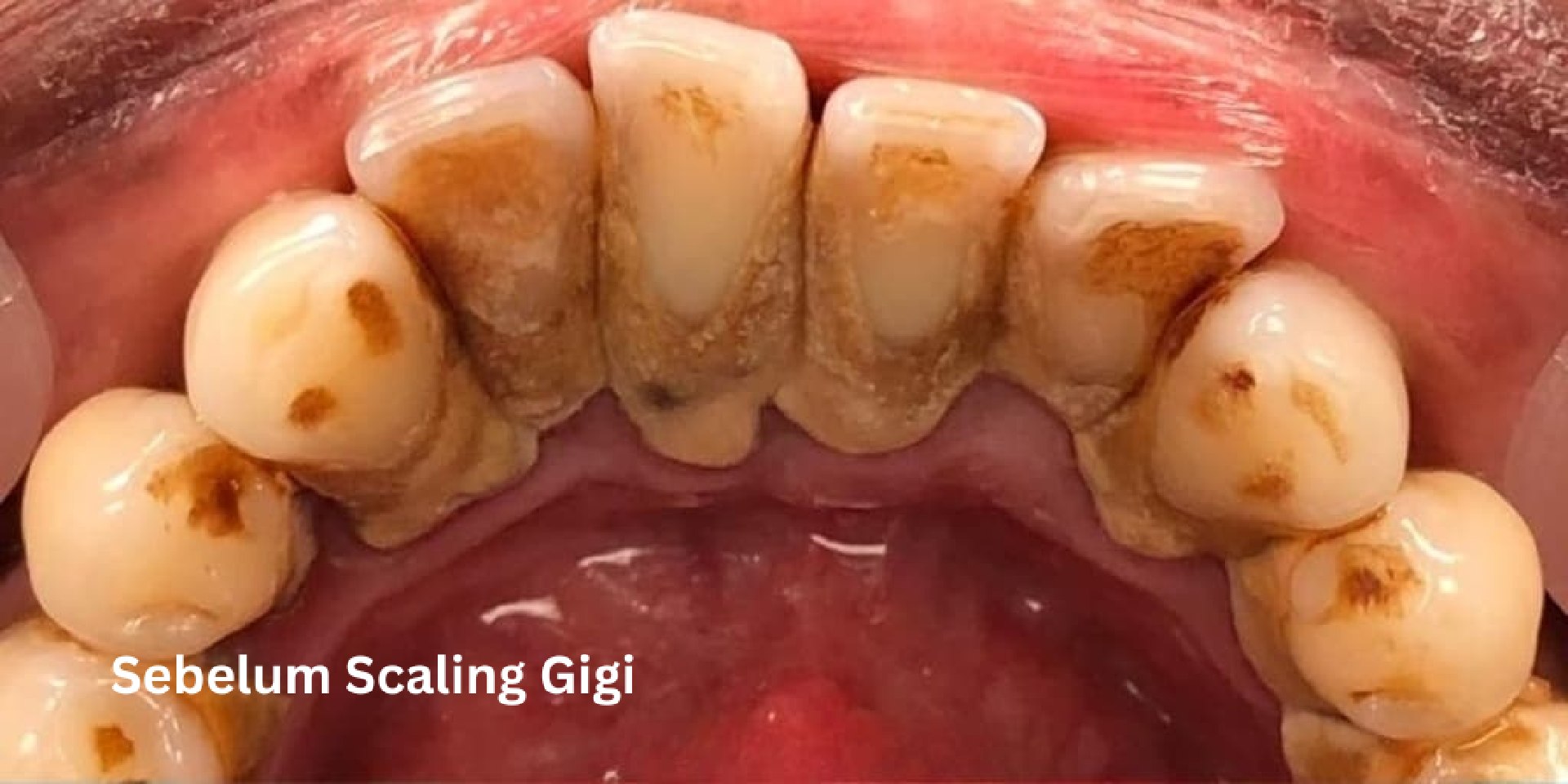 scaling-gigi-before-2