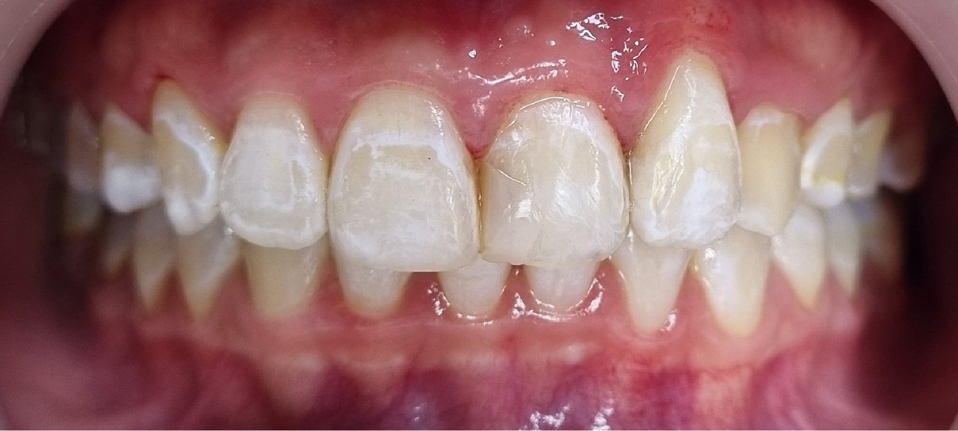 whitening-before