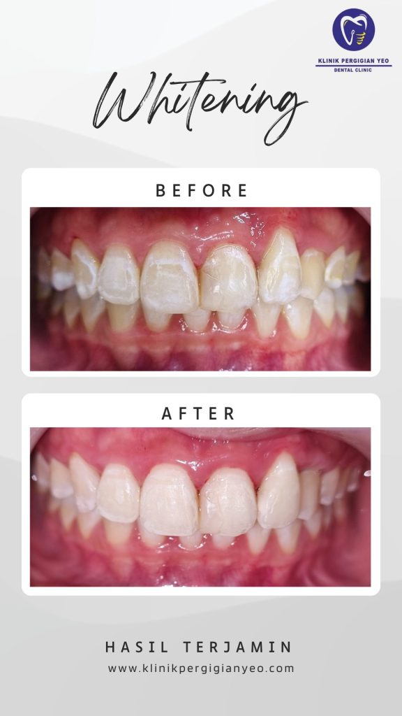Teeth whitening